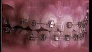 Straight teeth in under 60 seconds